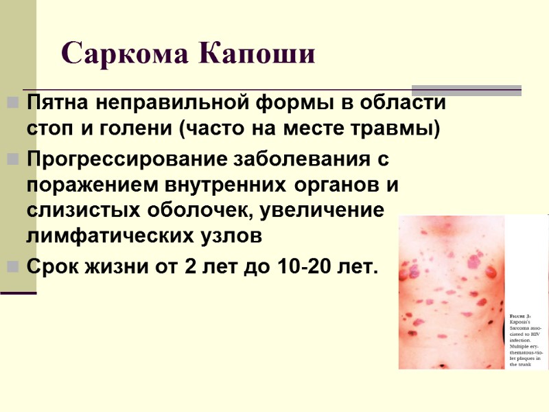 Саркома Капоши  Пятна неправильной формы в области стоп и голени (часто на месте